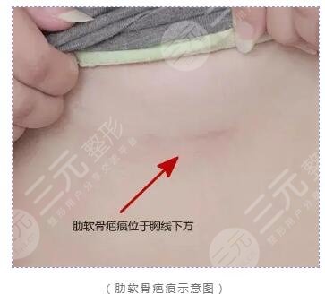 自體軟骨隆鼻術后注意事項