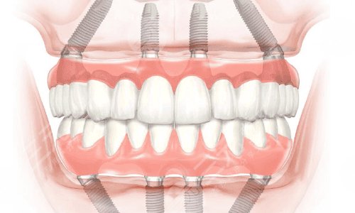 什么是全口種植牙