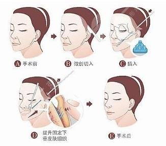 拉皮手術能維持幾年?多少錢?“恢復期_適合年齡”術前要了解哦~