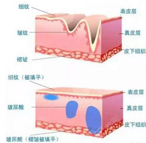 玻尿酸除皺