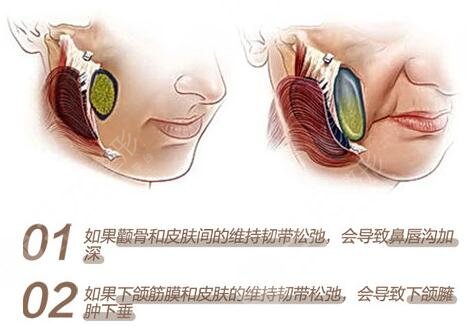 內(nèi)窺鏡除皺術(shù)缺點科普！手術(shù)果到底咋樣？一文解答你的困惑，附價格~