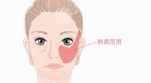 內(nèi)窺鏡拉皮手術(shù)術(shù)后會有什么樣的改變