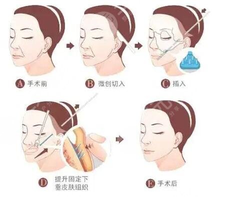 拉皮除皺手術(shù)有什么優(yōu)點(diǎn)