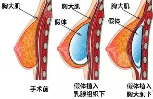 蜜桃假體隆胸手術(shù)的恢復(fù)時(shí)間