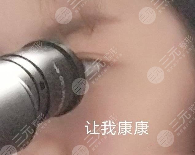 廈門海峽張宏做雙眼皮如何？