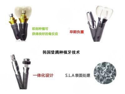 登騰種植牙后期穩(wěn)定性怎么樣