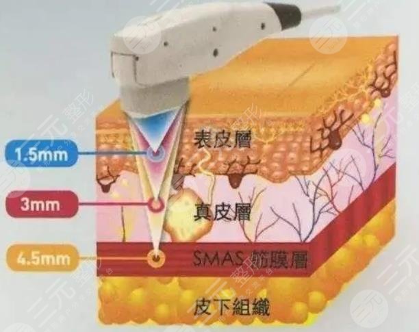 超聲提拉