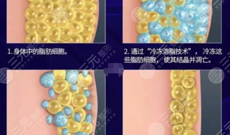 酷塑冷凍瘦身