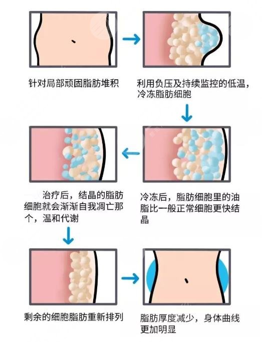 酷塑冷凍瘦身