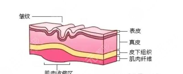 激光除皺