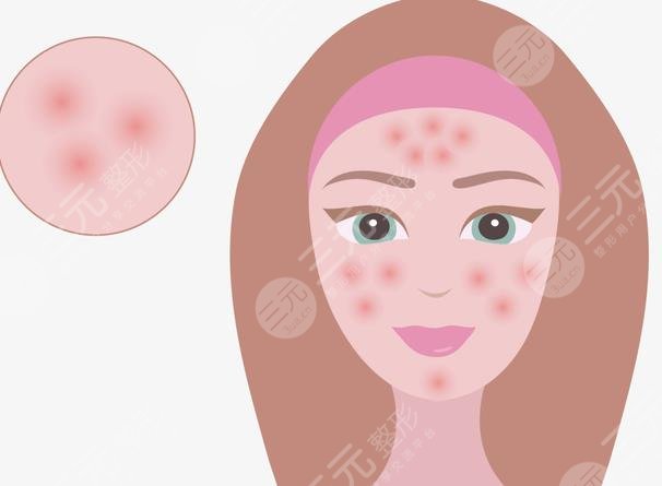 西京醫(yī)院微整形祛痘項(xiàng)目科普介紹