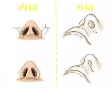 鼻翼縮小
