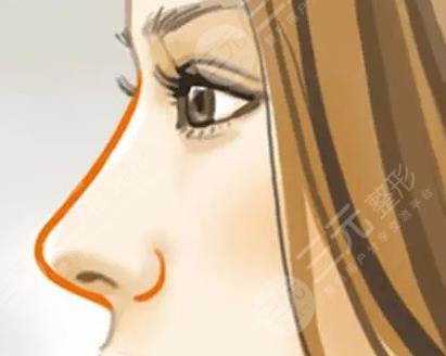 整形手術(shù)科普之鼻部整形相關(guān)介紹