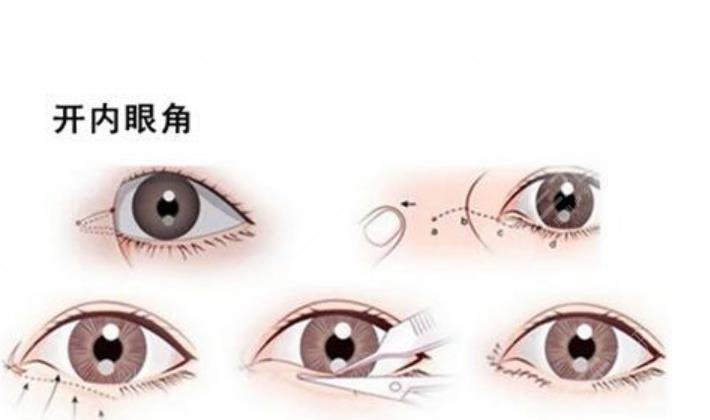 開(kāi)眼角