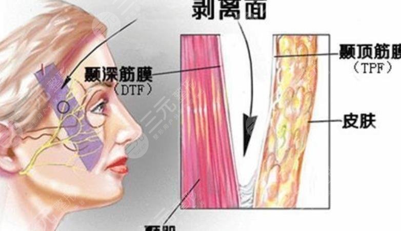 拉皮手術