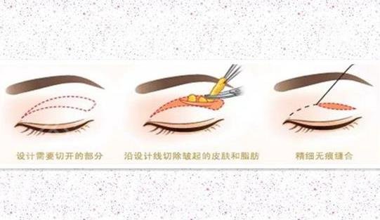 雙眼皮項目科普