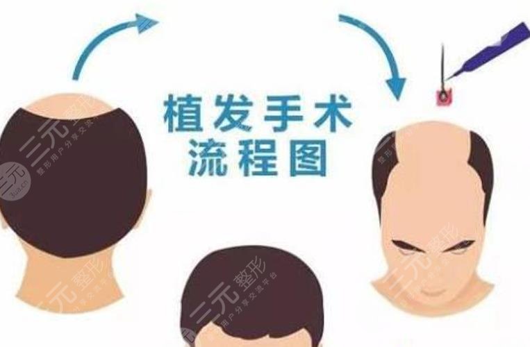 植發(fā)