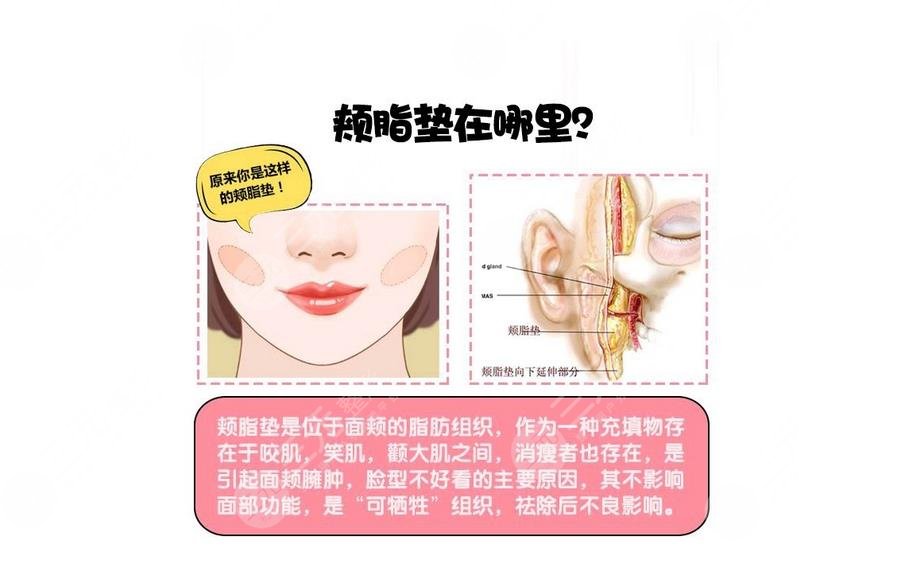 頰脂墊在哪個部位?去掉頰脂墊有什么危害?術前準備+術后護理~