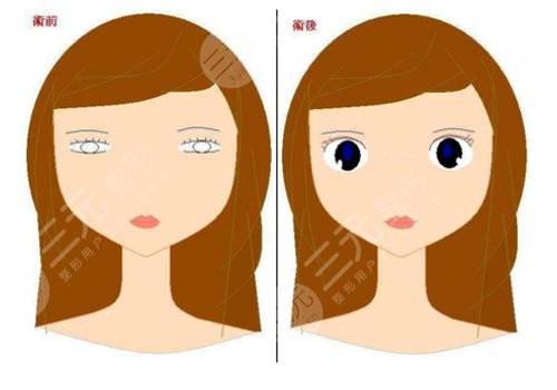 10個開內(nèi)眼角9個留疤怎么辦