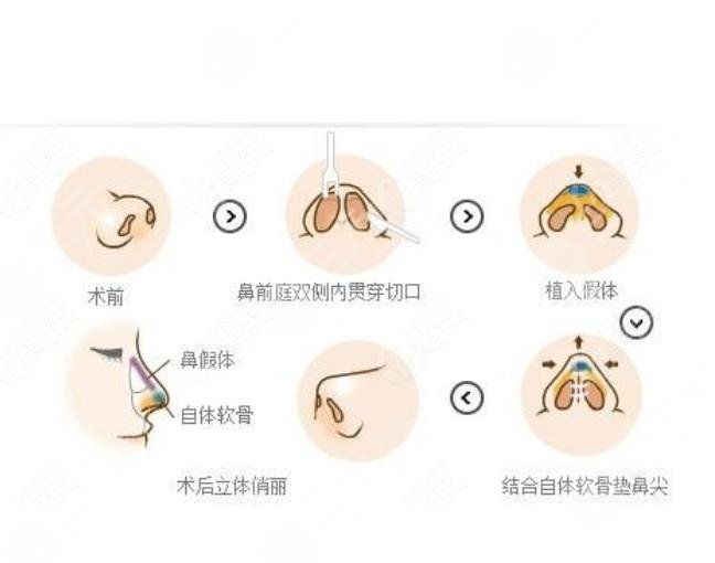 隆鼻失敗修復(fù)步驟是怎樣的?