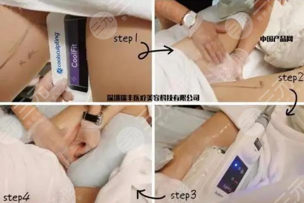 酷塑冷凍減脂