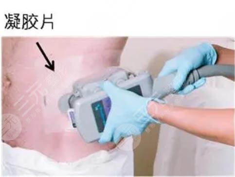 酷塑冷凍減脂