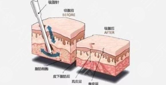5g光雕吸脂