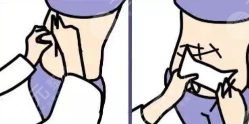 酷塑冷凍減脂