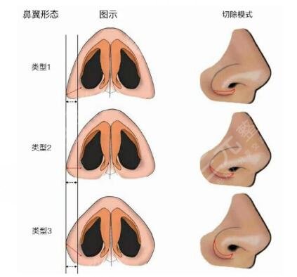 磨鼻骨手術(shù)原理