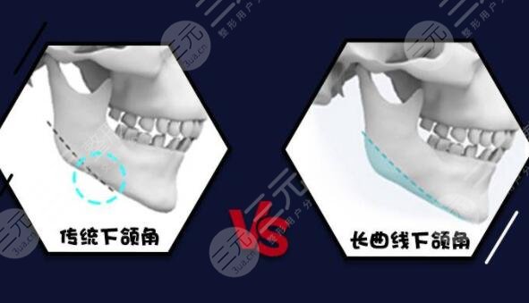 什么是下頜角整形手術(shù)