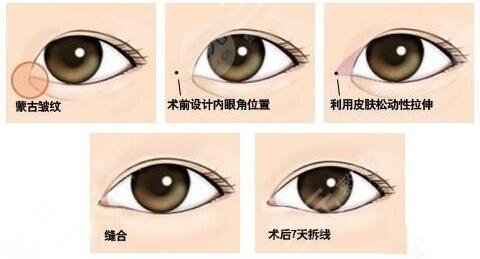 開內(nèi)眼角多久可以恢復