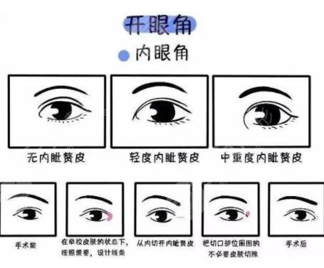 開內(nèi)眼角手術注意什么