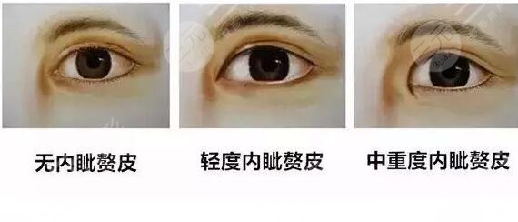 開眼角手術的成好嗎