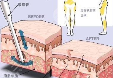 5g光雕吸脂
