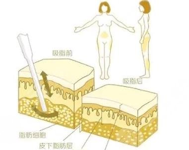 5g光雕吸脂