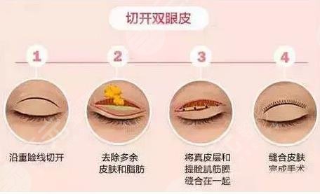 天津長(zhǎng)征醫(yī)院醫(yī)美雙眼皮整形經(jīng)歷分享