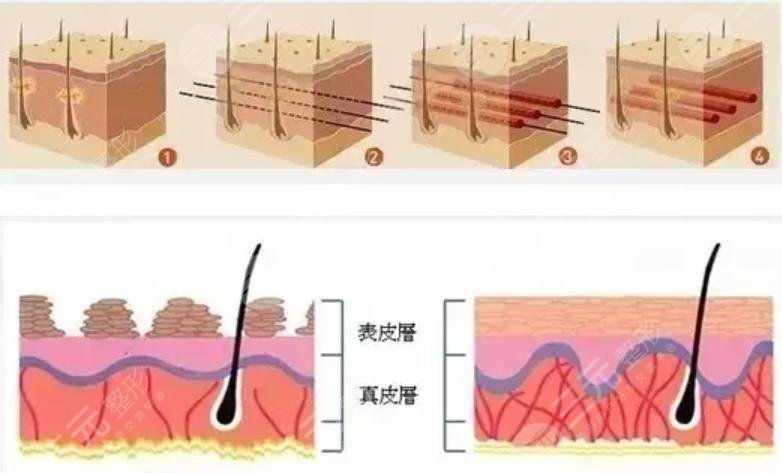 面部抗衰