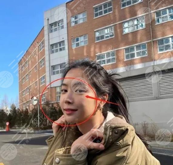 前Apink門面近照鼻子透光疑似整容失敗?
