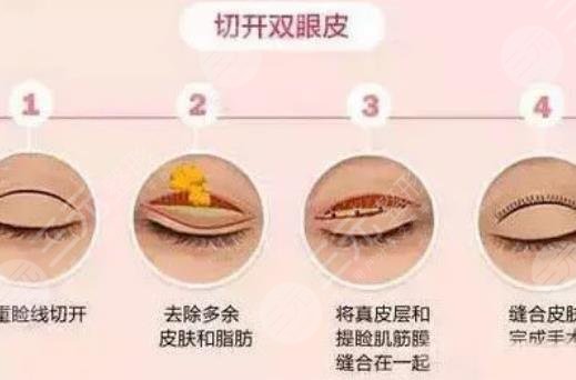 眼部手術(shù)手術(shù)可以和隆鼻一起做嗎?