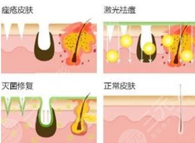 激光祛痘