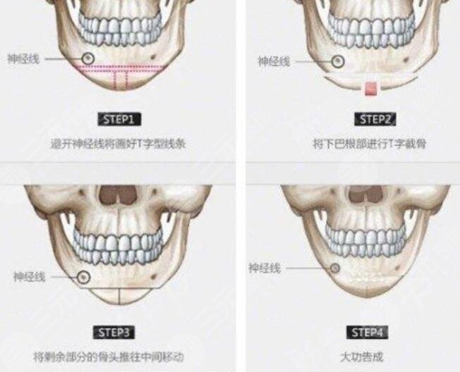 下頜角磨骨整形手術(shù)案例告訴你怎樣變瓜子臉，精致小臉不是夢