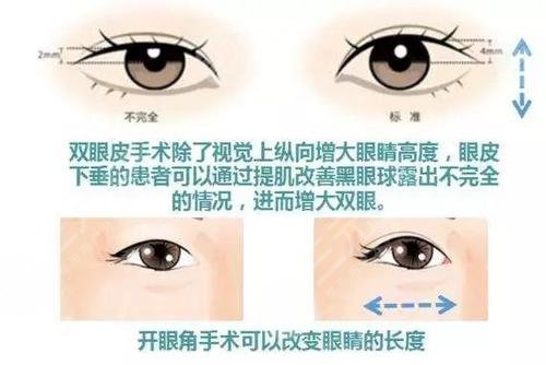 開(kāi)眼角對(duì)比果圖文講解！前后區(qū)別一覽，康康你是否需要do一下！