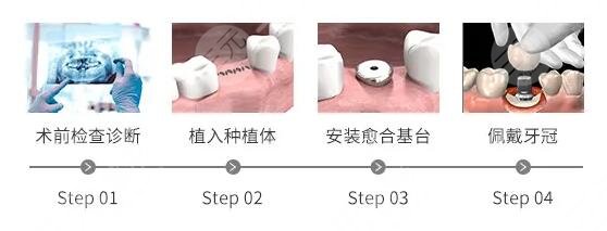 種植牙原理介紹