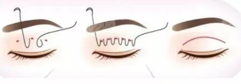 割自然平行雙眼皮7mm寬果圖全過程分享