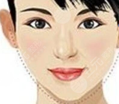 墊下巴多長時(shí)間恢復(fù)|隆鼻整形+假體墊下巴真實(shí)案例分享