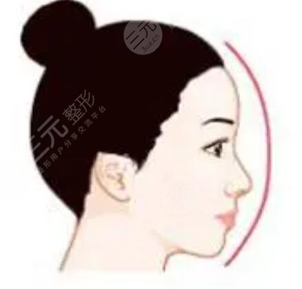 假體隆鼻修復+肋軟骨墊鼻尖真實案例分享