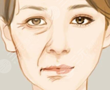 內(nèi)切去眼袋+詳細(xì)部自體脂肪填充真實(shí)案例果對(duì)比圖