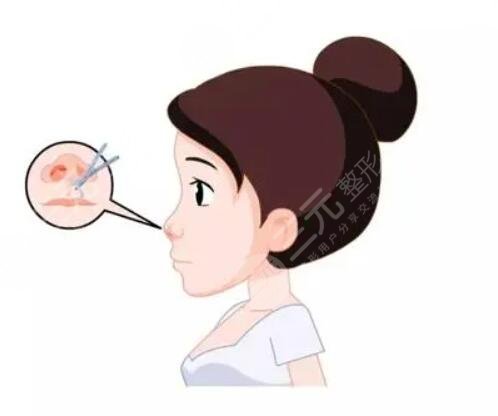 假體隆鼻+耳軟骨墊鼻尖果對比圖，親身經(jīng)歷分享