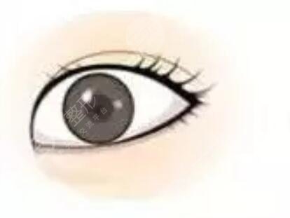 全切扇形雙眼皮恢復(fù)6個月很好看喲~