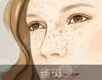 彩光去雀斑